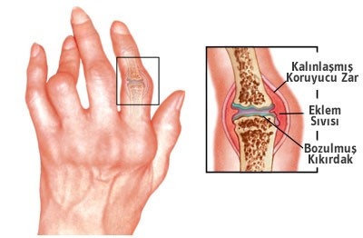 Isırgan otu, kiraz Sapı Kürü ile iltihaplı eklem romatizması tedavisi