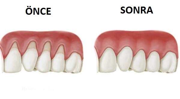 Diş Eti Çekilmesi İle Savaşan Doğal Yöntem