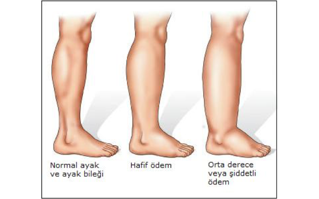 Ödem Söktürücü Formül