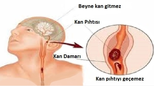 Vücudunuz Felç Geçirmeden Önce Sizi Uyarıyor