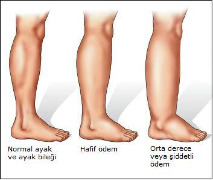 Ödem atmanın en basit 9 yolu