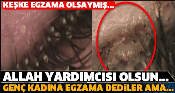 Genç Kadına Egzama Dediler Ama Keşke Egzama Olsaydı Diyeceksiniz Allah Yardımcısı Olsun