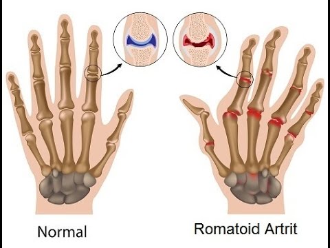 İltihaplı Eklem Romatizması ve Sinir Sıkışması için Karışım