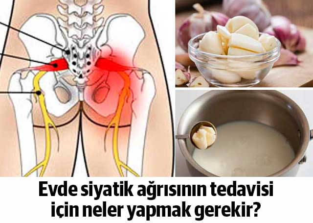 Siyatik ağrısı nasıl geçer Tedavi için doğal kürler