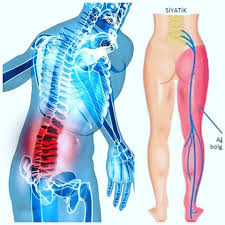 Siyatik ağrısı nasıl geçer Tedavi için doğal kürler