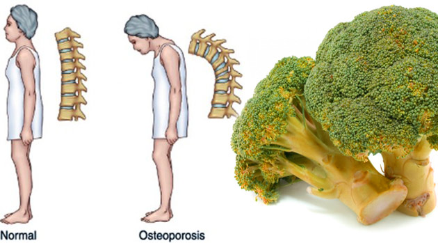 Kemik Erimesini Durduran Mucize Sebze Brokoli Bakın Nasıl Tüketiliyor