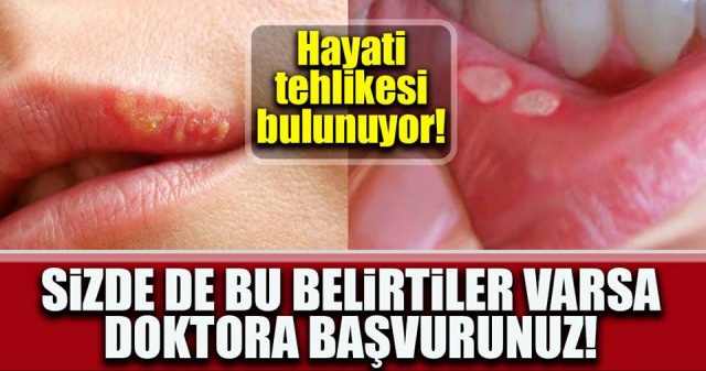 Ağız İçi Yaralarının Sebebi Nedir Neler Yapılabilir