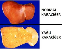 Karaciğer Yağlanmasını En Aza İndiren ve Kilo Verdiren 3 Günlük Kür