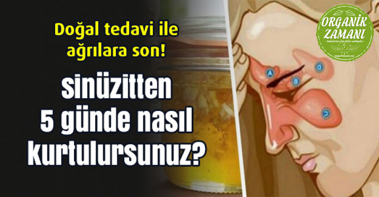 Sinüzitten 5 Günde Nasıl Kurtulursunuz