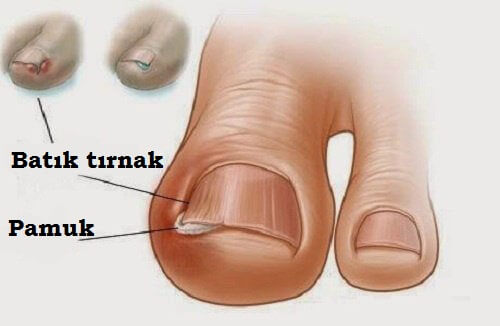 Tırnak Batmasına Doğal Çözüm Yolu