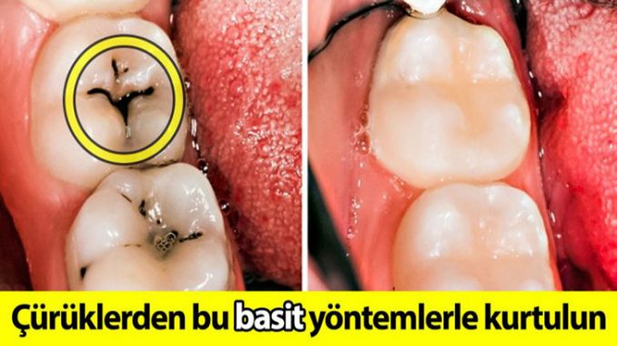 Dişteki oyukları doldurmanın ve çürükleri iyileştirmenin basit yolu