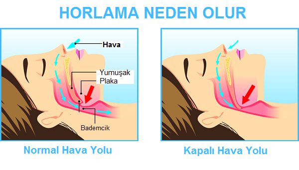 Dikkat! Horlama neden olur? Hangi hastalıklara sebep oluyor