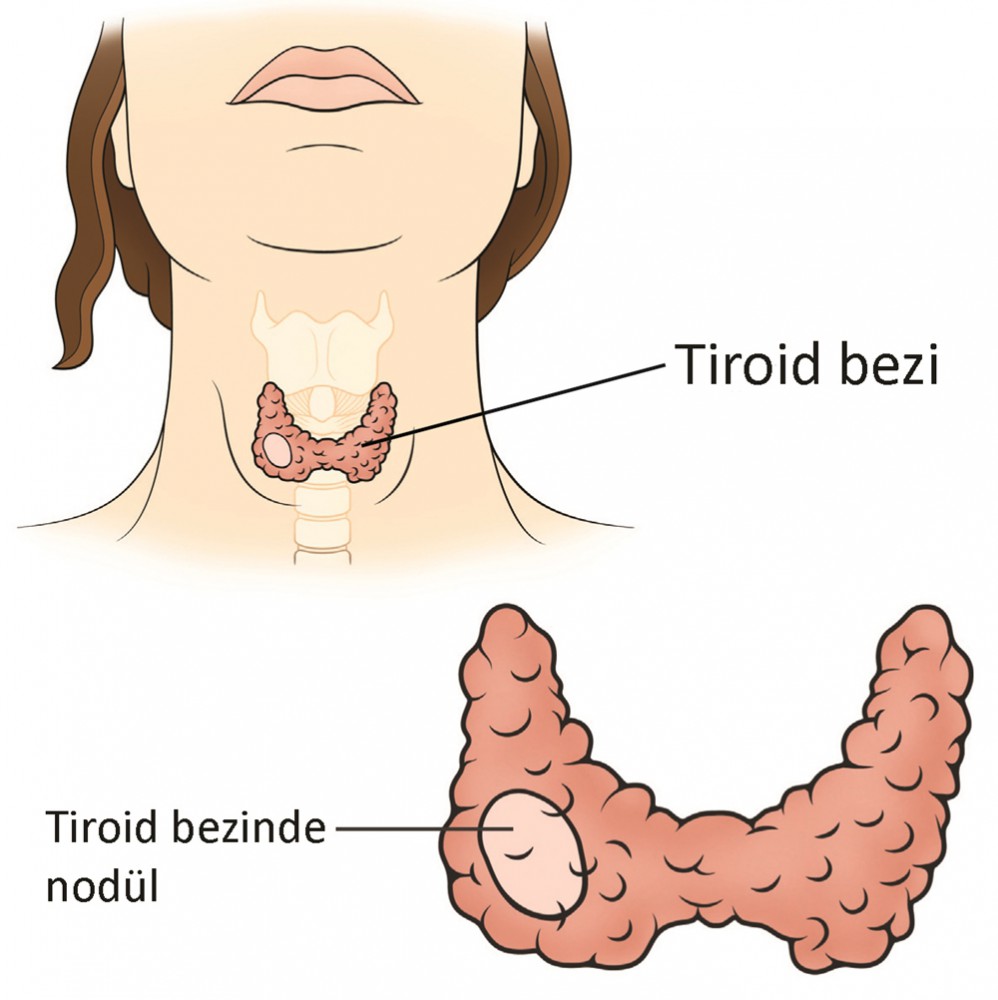 İşte Tiroid Hastası Olduğunuzun 6 Gizli İşareti