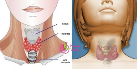 İşte Tiroid Hastası Olduğunuzun 6 Gizli İşareti