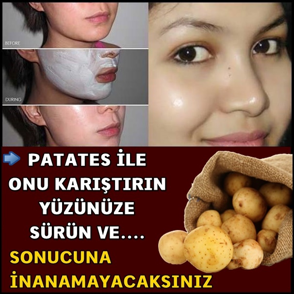 Patates İle Onu Karştırın Yüzüne Sürün.Sonucu Görün