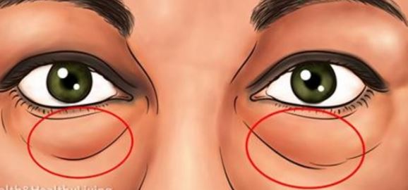 Göz Altı Torbaları ve Mor Halkalardan Kurtulmanın Doğal Yolları