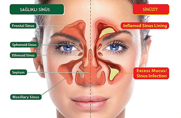 Sinüzit ve Migren Ağrılarına Bu Şekilde Son Verebilirsiniz