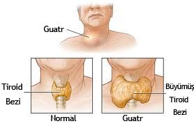 Tiroid bozukluğunun en önemli 13 belirtisi..
