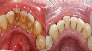 Diş taşlarınızı doğal yöntemlerle yok etmek artık mümkün…