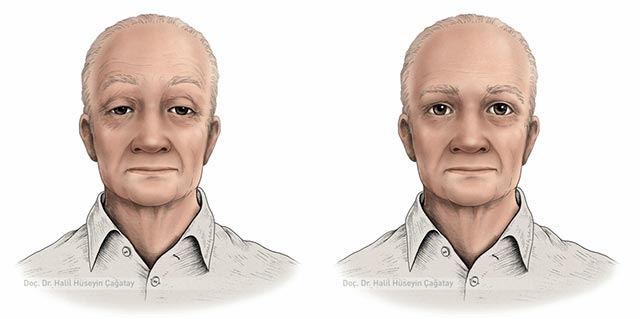 Göz Kapağı Düşüklüğü Ciddi Bir Sorunun Habercisi Olabilir