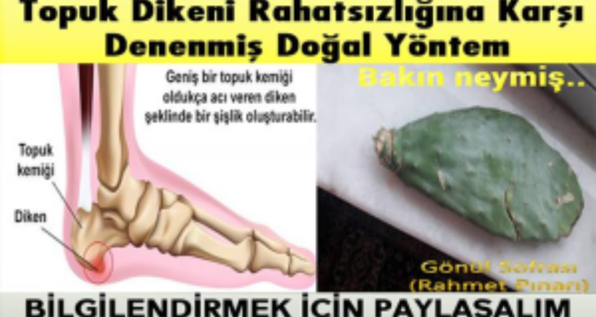 Topuk dikenine karşı denenmiş doğal yöntemler..