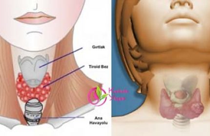Tiroid Hastası Olduğunuzun 6 Gizli İşareti. Bende Yoktur Demeyin Mutlaka Kontrol Edin